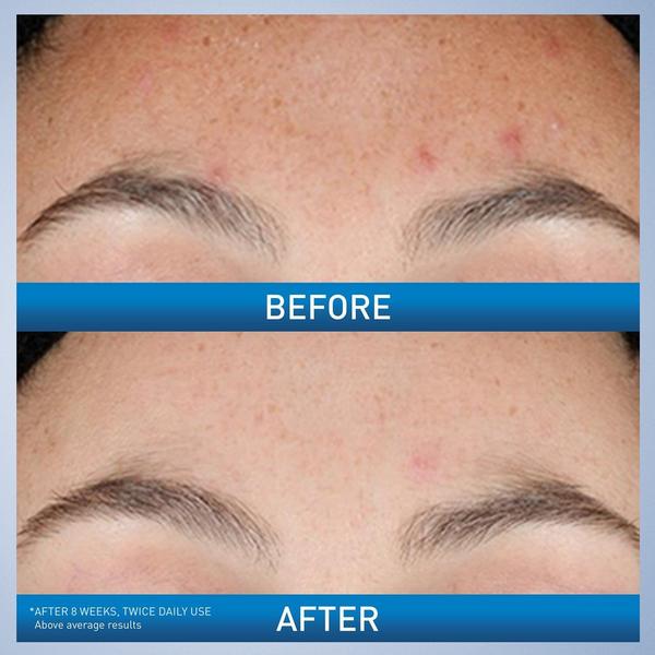 Resurfacing Retinol Facial Serum for Acne Prone Skin