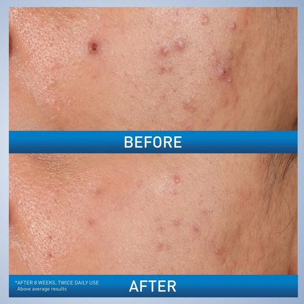 Acne Control Gel Blemish Treatment with AHA & BHA for Acne Prone Skin