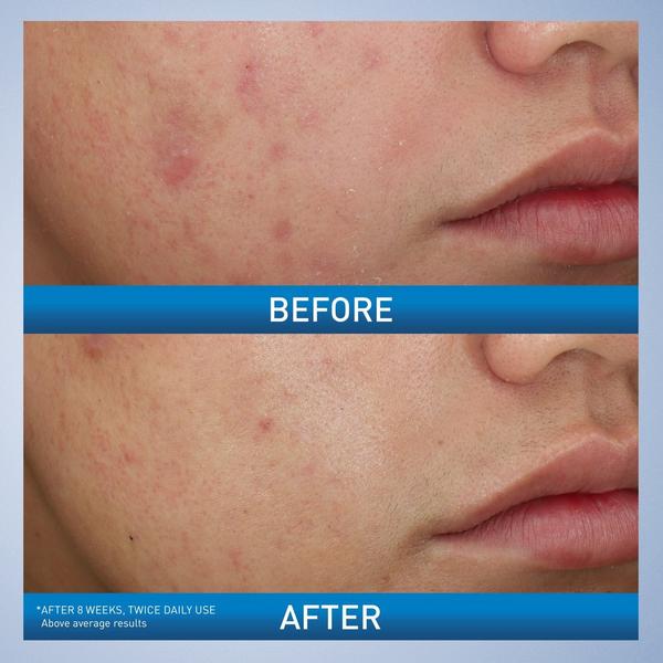 Maximum Strength Acne Foaming Cream Wash with 10% BPO for Face & Body