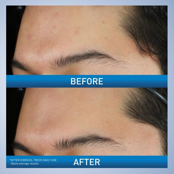 Maximum Strength Acne Foaming Cream Wash with 10% BPO for Face & Body