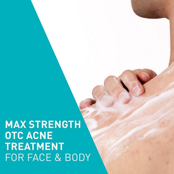 Maximum Strength Acne Foaming Cream Wash with 10% BPO for Face & Body